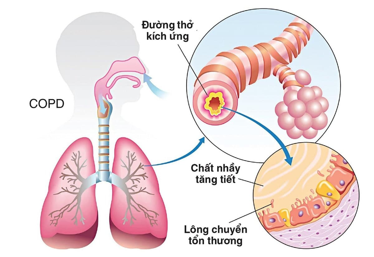 Ho và thở khò khè là triệu chứng của bệnh gì? Cách xử lý?